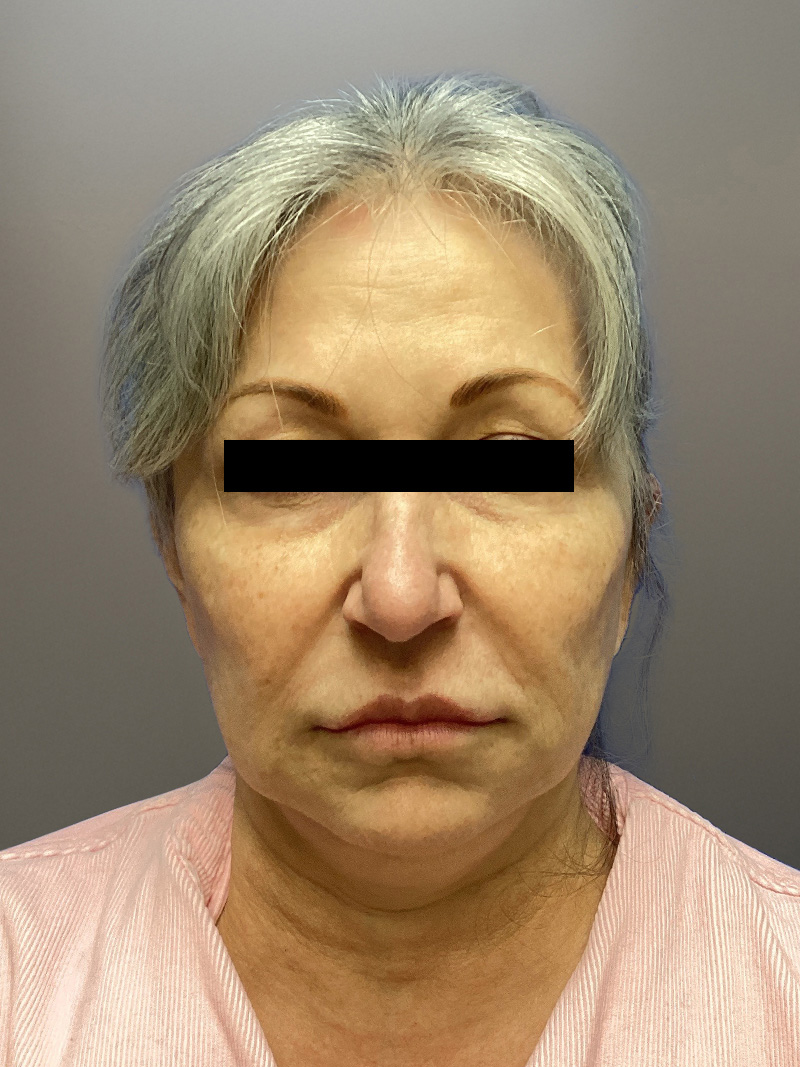 FACELIFT Before & After Gallery - Patient 680925 - Image 1