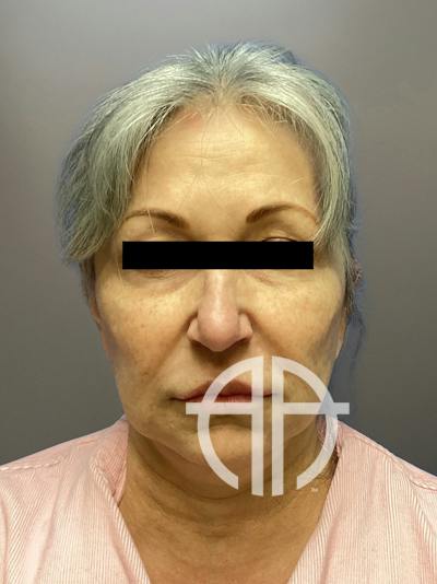 FACELIFT Before & After Gallery - Patient 680925 - Image 1