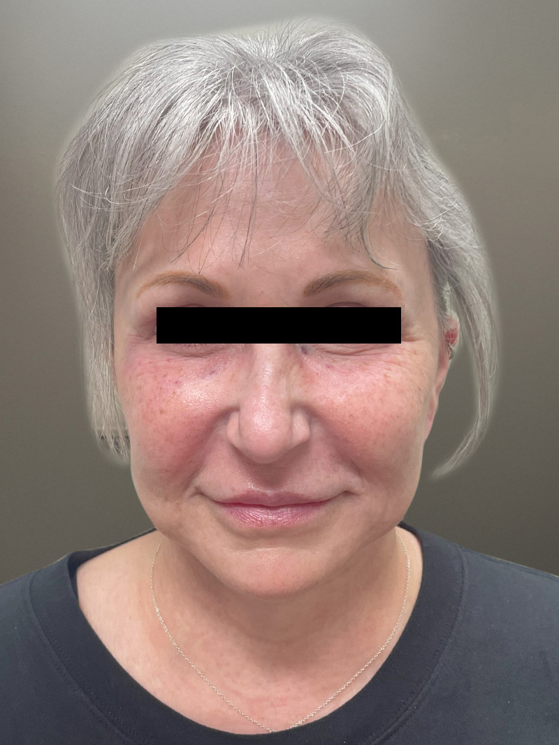 FACELIFT Before & After Gallery - Patient 680925 - Image 2