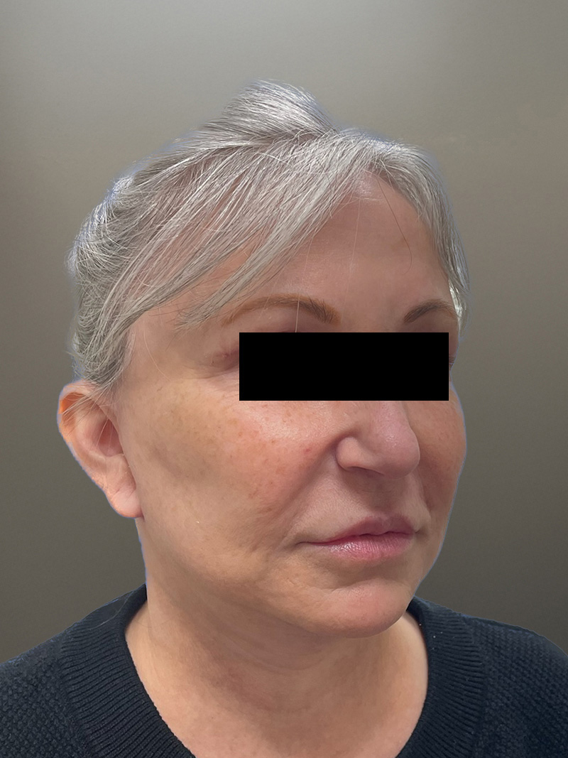 FACELIFT Before & After Gallery - Patient 680925 - Image 4