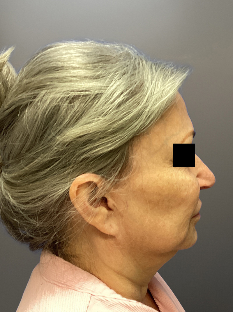 FACELIFT Before & After Gallery - Patient 680925 - Image 5