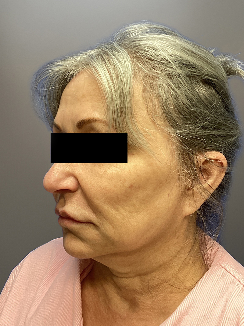 FACELIFT Before & After Gallery - Patient 680925 - Image 7