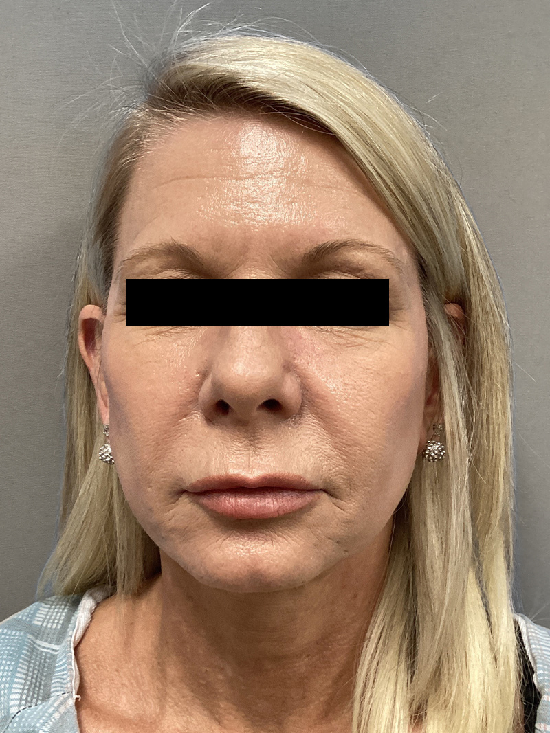 FACELIFT Before & After Gallery - Patient 906713 - Image 1