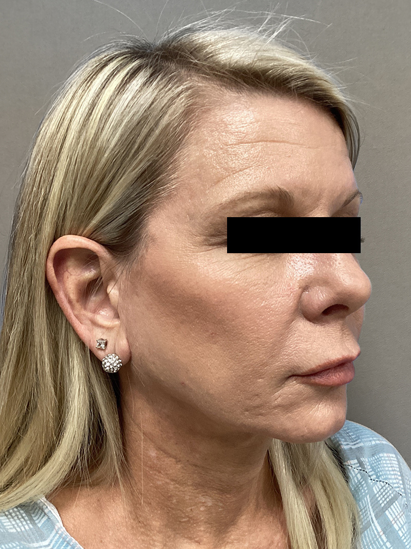 FACELIFT Before & After Gallery - Patient 906713 - Image 3