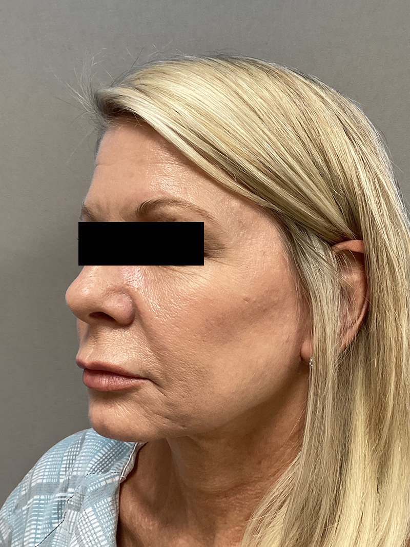 FACELIFT Before & After Gallery - Patient 906713 - Image 9
