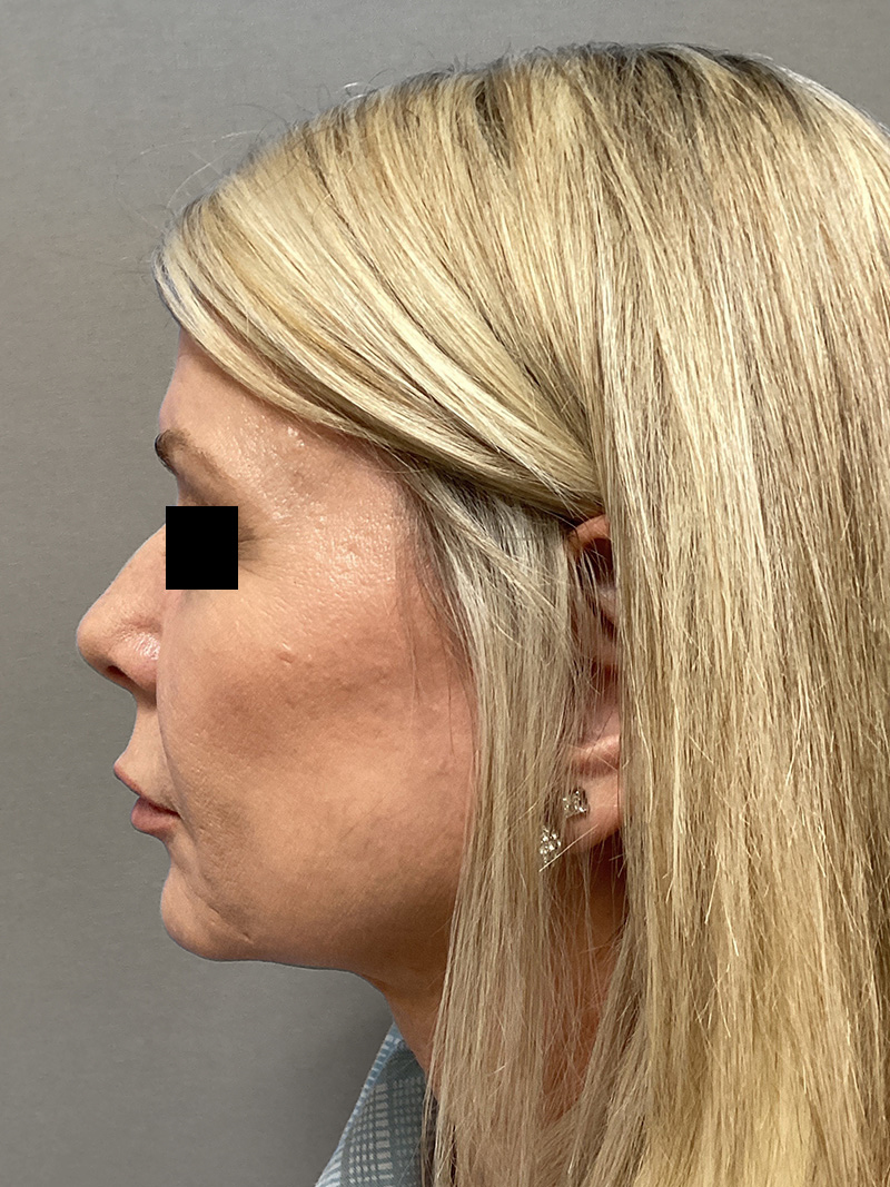 FACELIFT Before & After Gallery - Patient 906713 - Image 7