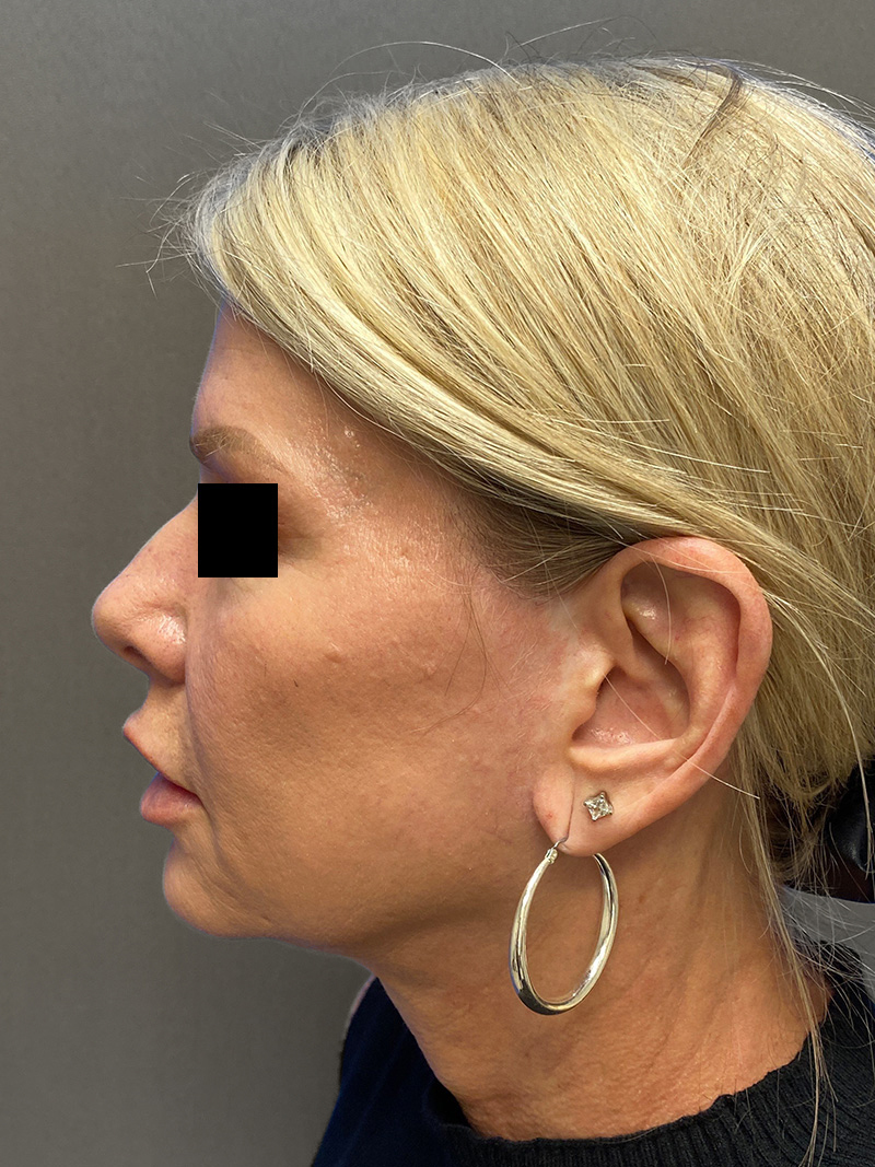 FACELIFT Before & After Gallery - Patient 906713 - Image 8