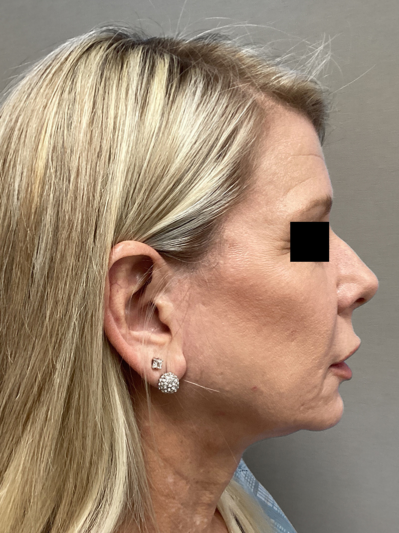FACELIFT Before & After Gallery - Patient 906713 - Image 5