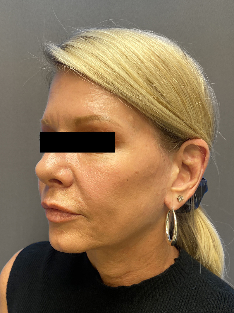 FACELIFT Before & After Gallery - Patient 906713 - Image 10