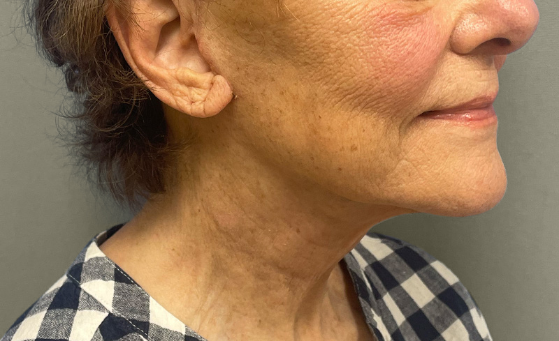 NECK LIFT Before & After Gallery - Patient 107557 - Image 6
