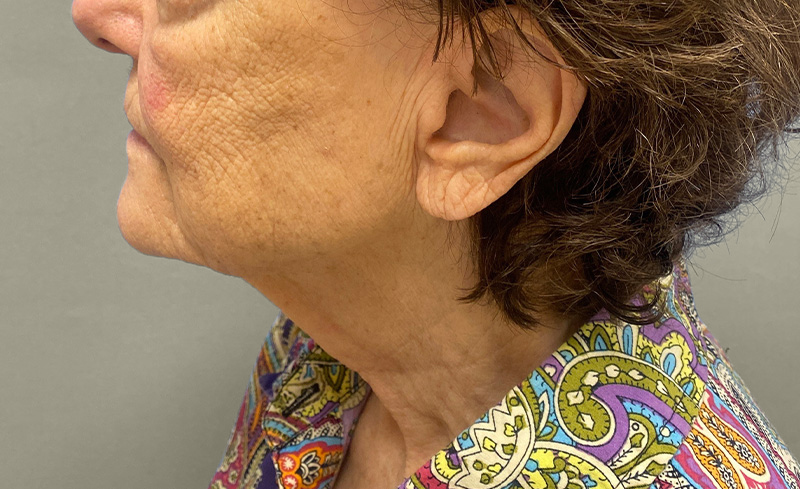 NECK LIFT Before & After Gallery - Patient 107557 - Image 1