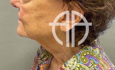 NECK LIFT Before & After Gallery - Patient 107557 - Image 1