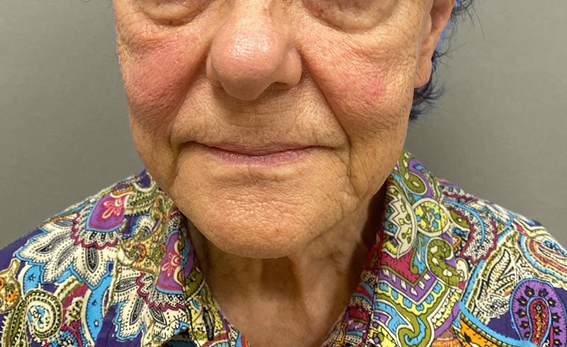 NECK LIFT Before & After Gallery - Patient 107557 - Image 3