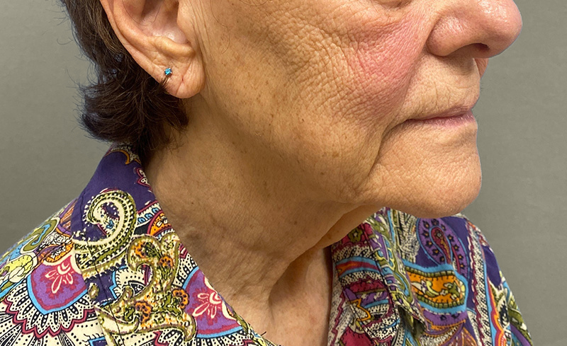 NECK LIFT Before & After Gallery - Patient 107557 - Image 5