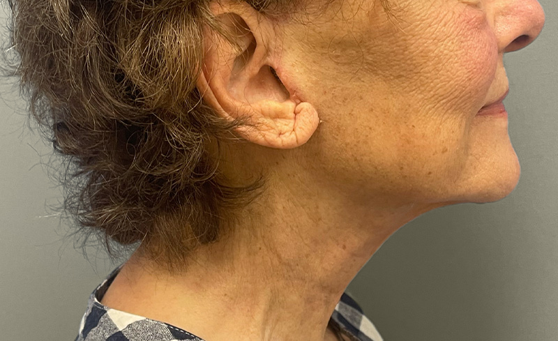 NECK LIFT Before & After Gallery - Patient 107557 - Image 8