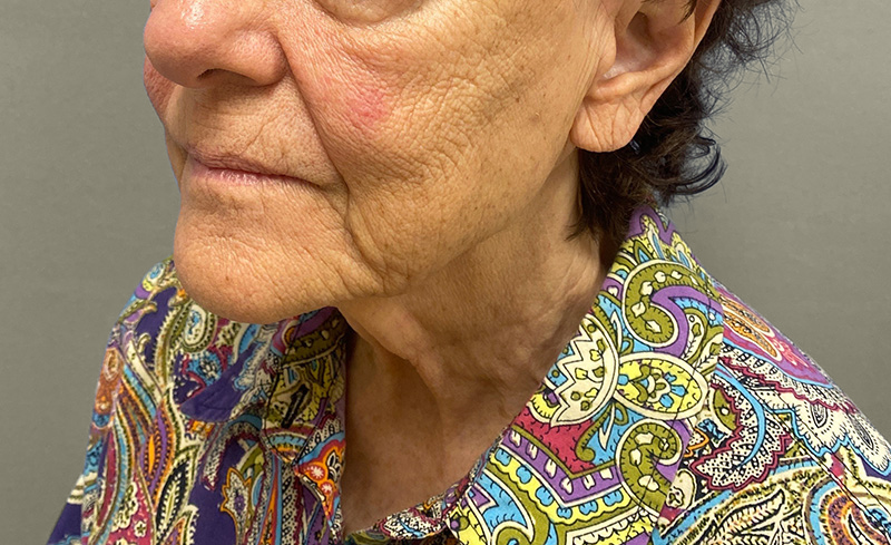NECK LIFT Before & After Gallery - Patient 107557 - Image 9