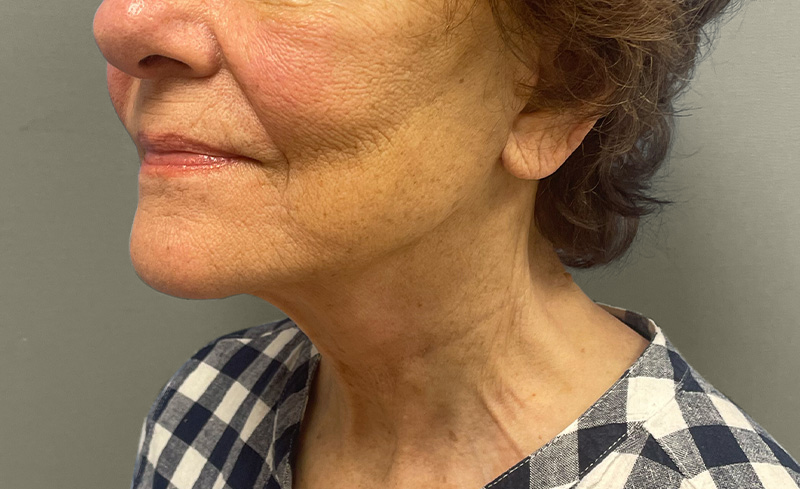 NECK LIFT Before & After Gallery - Patient 107557 - Image 10
