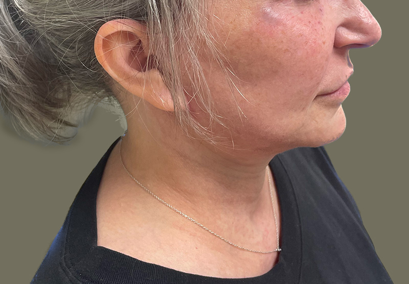 NECK LIFT Before & After Gallery - Patient 118807 - Image 2