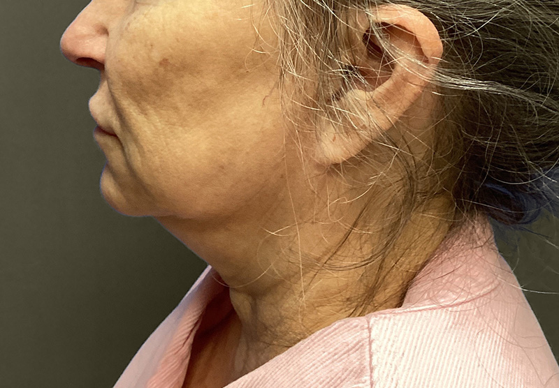 NECK LIFT Before & After Gallery - Patient 118807 - Image 3