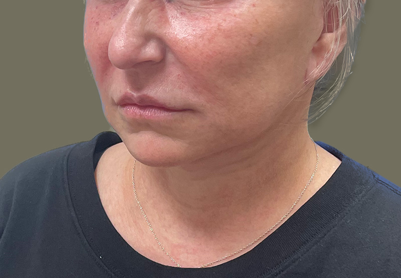 NECK LIFT Before & After Gallery - Patient 118807 - Image 10