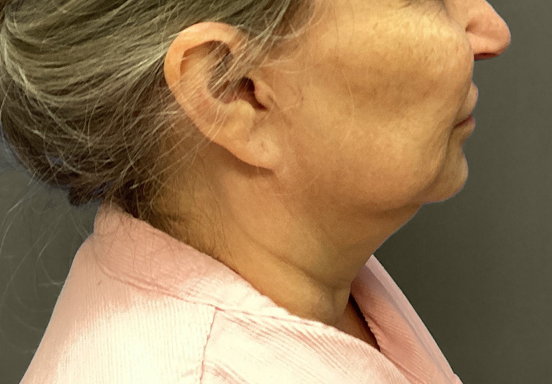 NECK LIFT Before & After Gallery - Patient 118807 - Image 1