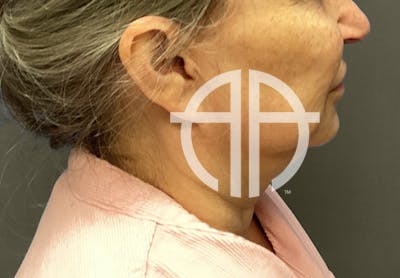 NECK LIFT Before & After Gallery - Patient 118807 - Image 1