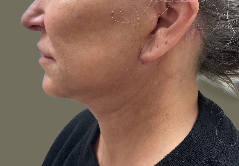 NECK LIFT Before & After Gallery - Patient 118807 - Image 4