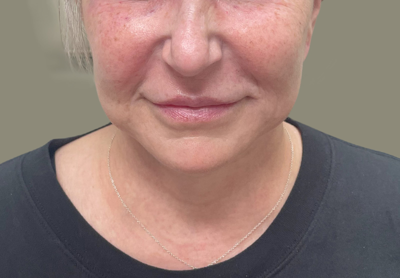 NECK LIFT Before & After Gallery - Patient 118807 - Image 6