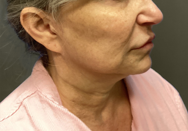 NECK LIFT Before & After Gallery - Patient 118807 - Image 7
