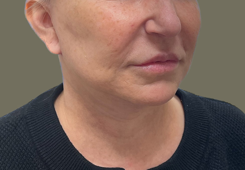 NECK LIFT Before & After Gallery - Patient 118807 - Image 8