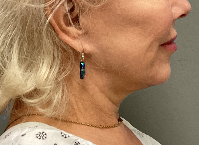 NECK LIFT Before & After Gallery - Patient 151125 - Image 1