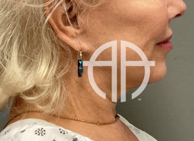 NECK LIFT Before & After Gallery - Patient 151125 - Image 1