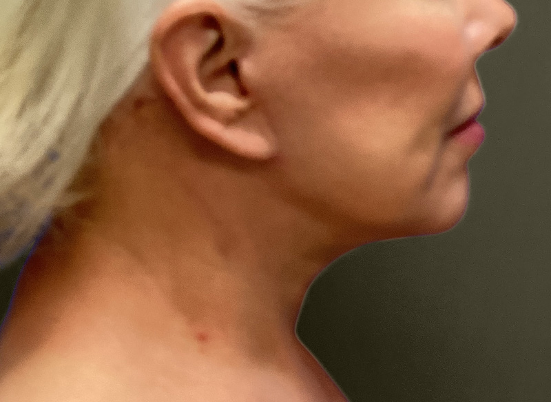 NECK LIFT Before & After Gallery - Patient 151125 - Image 2