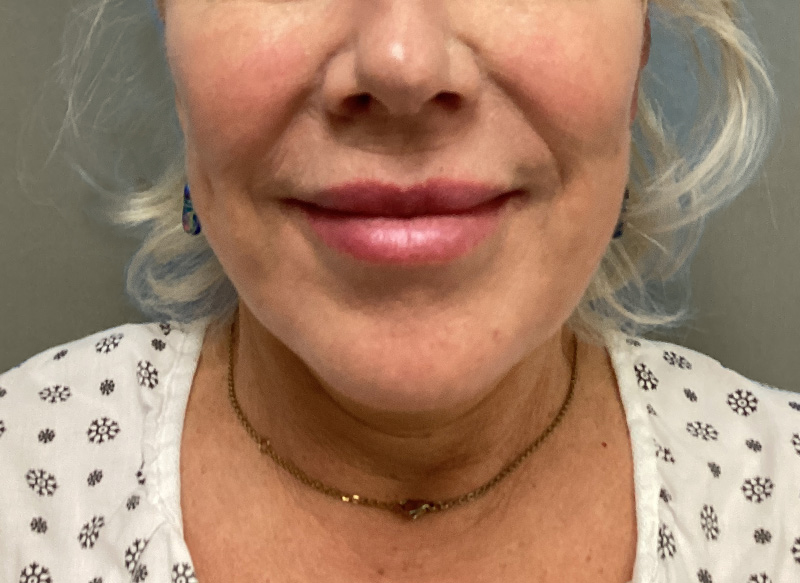 NECK LIFT Before & After Gallery - Patient 151125 - Image 5