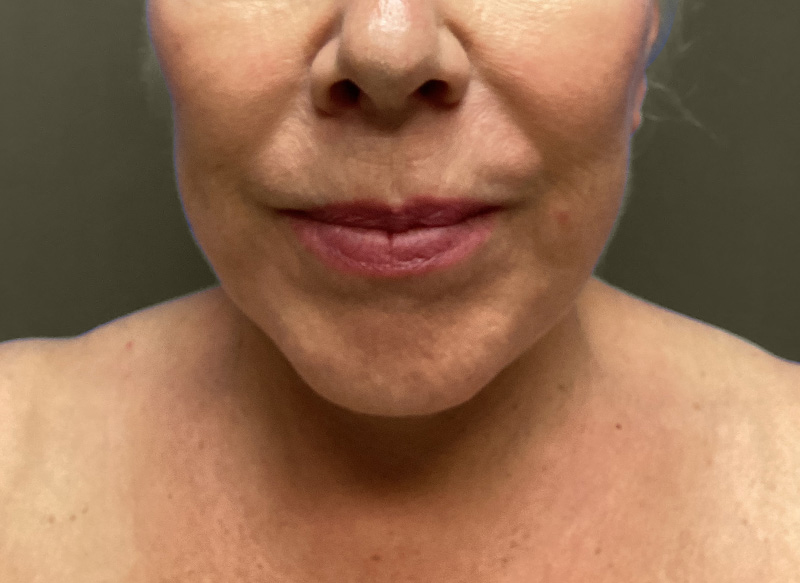 NECK LIFT Before & After Gallery - Patient 151125 - Image 6