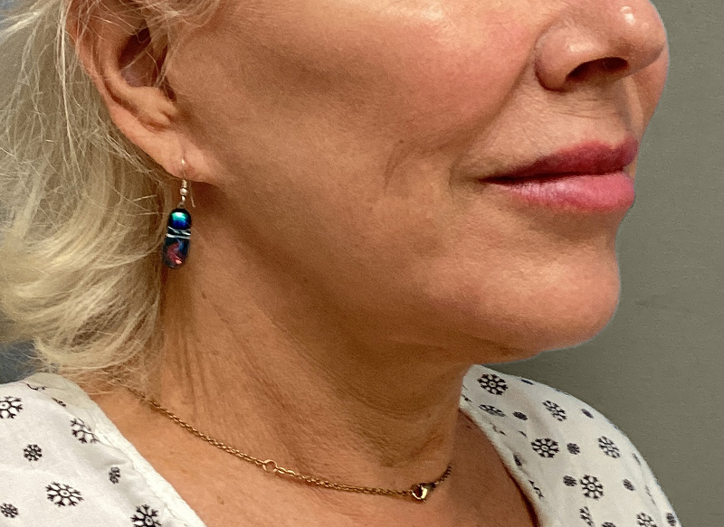 NECK LIFT Before & After Gallery - Patient 151125 - Image 3