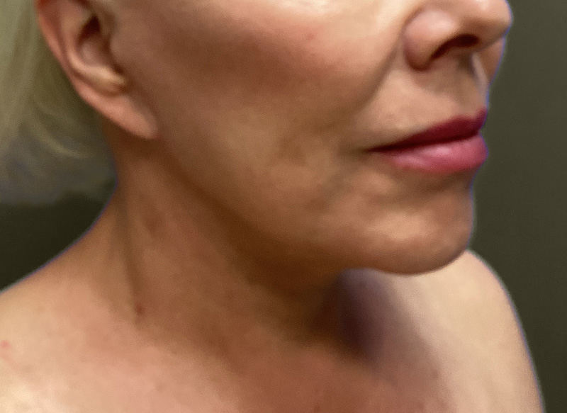 NECK LIFT Before & After Gallery - Patient 151125 - Image 4