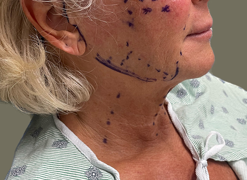 NECK LIFT Before & After Gallery - Patient 157367 - Image 1