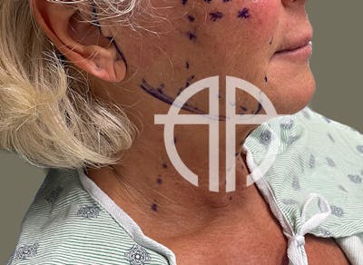 NECK LIFT Before & After Gallery - Patient 157367 - Image 1