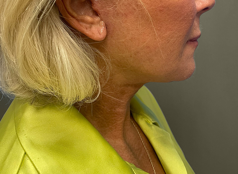 NECK LIFT Before & After Gallery - Patient 157367 - Image 2