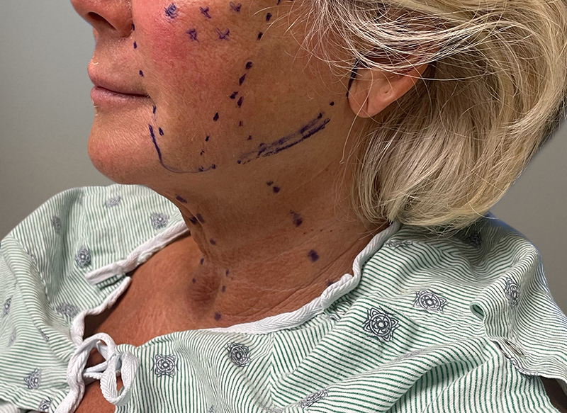 NECK LIFT Before & After Gallery - Patient 157367 - Image 3