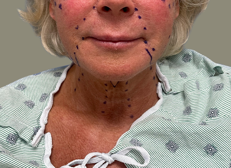 NECK LIFT Before & After Gallery - Patient 157367 - Image 5