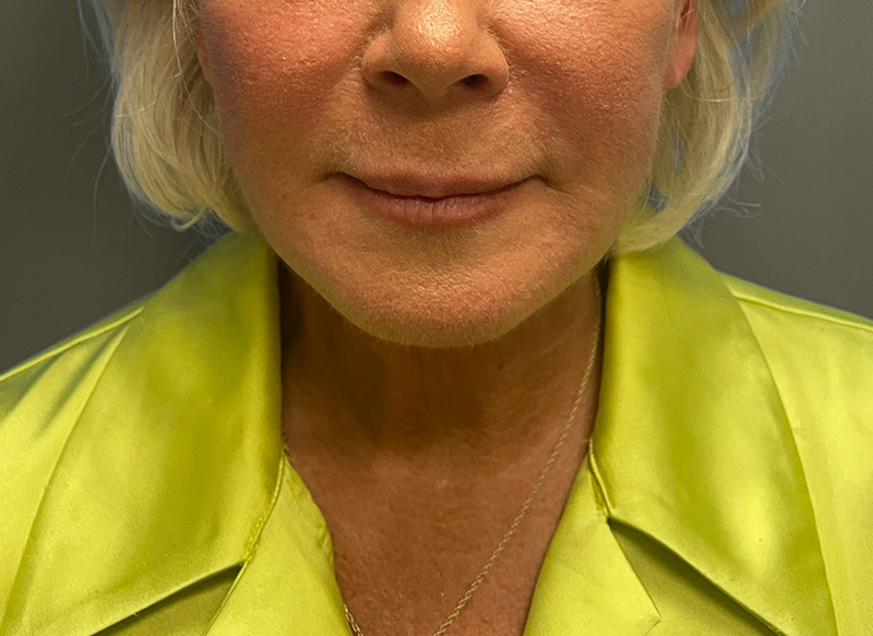 NECK LIFT Before & After Gallery - Patient 157367 - Image 6