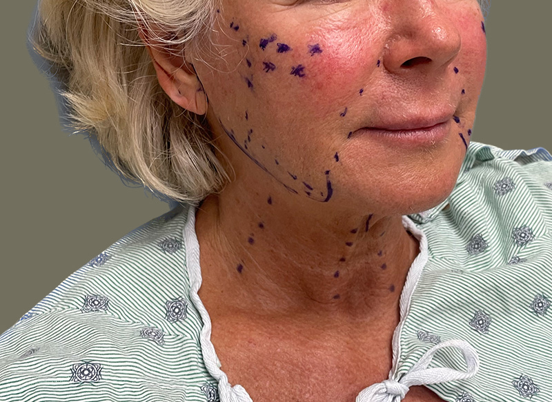 NECK LIFT Before & After Gallery - Patient 157367 - Image 7