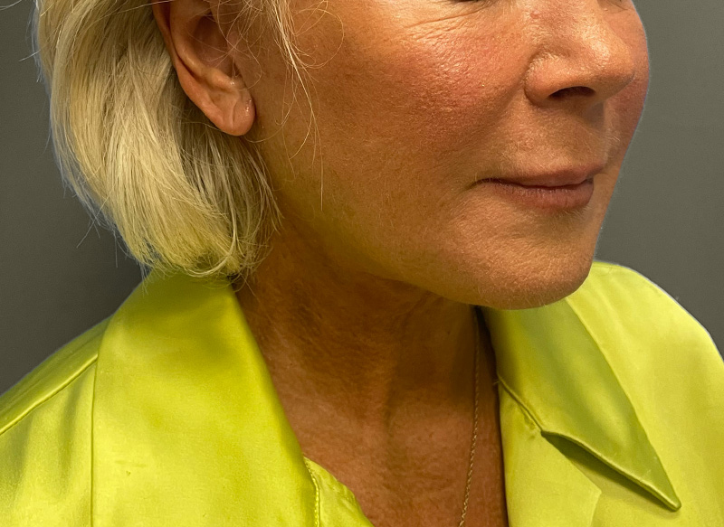 NECK LIFT Before & After Gallery - Patient 157367 - Image 8