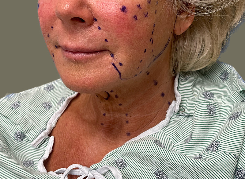 NECK LIFT Before & After Gallery - Patient 157367 - Image 9