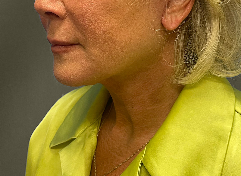 NECK LIFT Before & After Gallery - Patient 157367 - Image 10