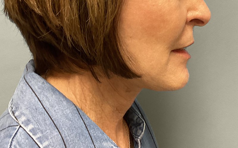 NECK LIFT Before & After Gallery - Patient 159366 - Image 1