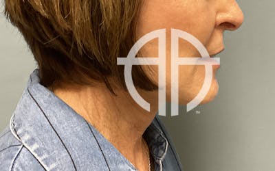 NECK LIFT Before & After Gallery - Patient 159366 - Image 1
