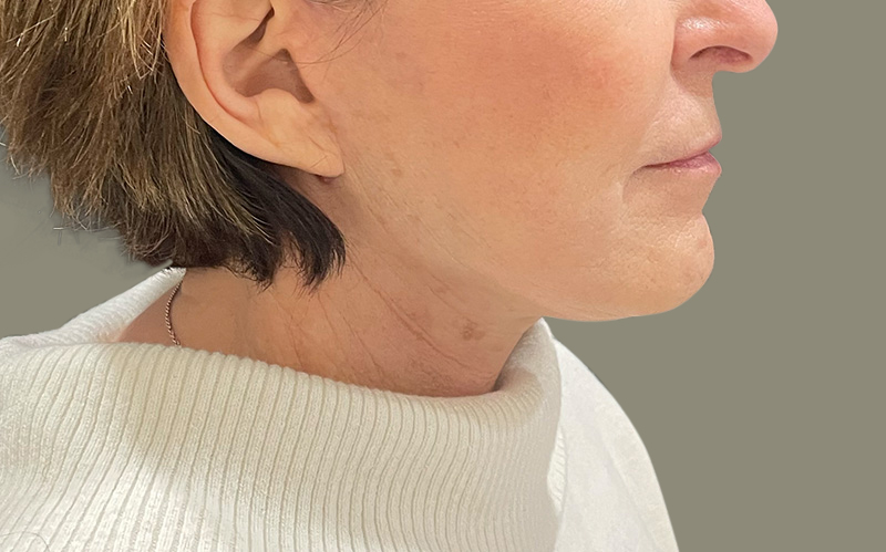 NECK LIFT Before & After Gallery - Patient 159366 - Image 2